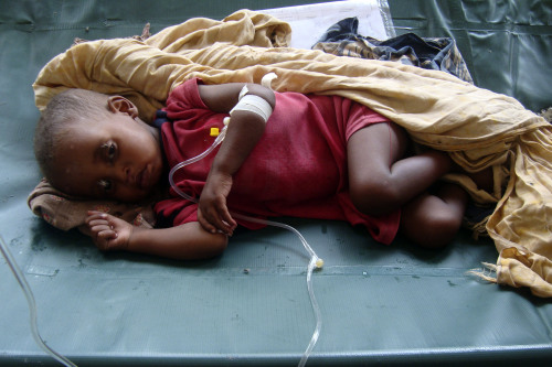 A malnourished child from southern Somalia lies in a hospital on Saturday. (AP-Yonhap News)