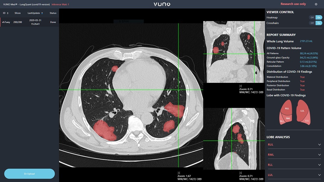 AI chest CT analysis solution (Vuno)