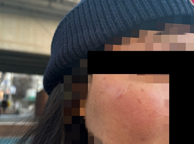 A photo shows the swollen face of a woman who was assaulted by a Korean man in his 30s in Seoul, at around 4 p.m. on Friday. (Photo provided by victim)
