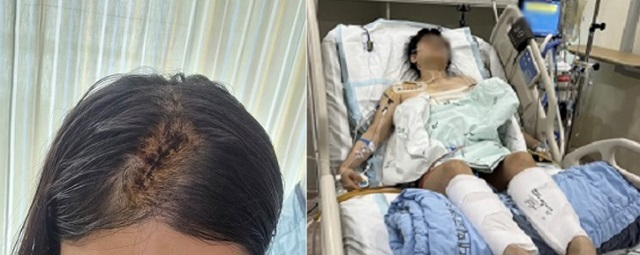 These photos posted by the victim’s family show the scar on the victim’s head (left), and the victim being treated at the hospital for the injuries inflicted by the defendant’s attack. (Nate.com)