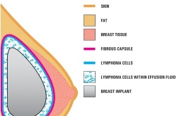 Are ‘water drop’ breast implants a ticking time bomb in the chest?