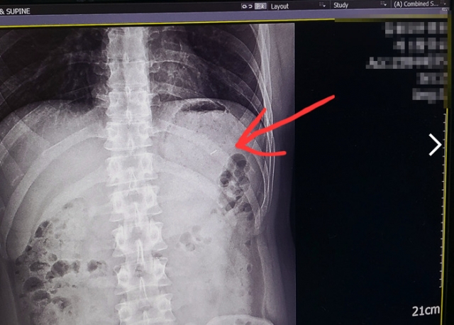 An X-ray image showing what is claimed to be a metal pin (Bobaedream)