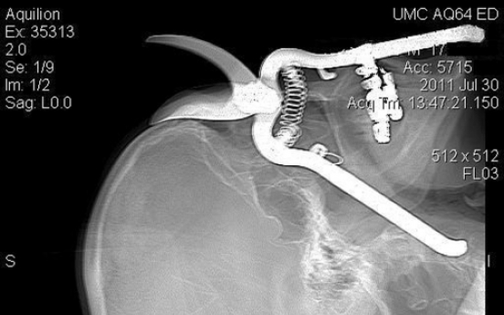 Ariz. man impaled by pruning shears