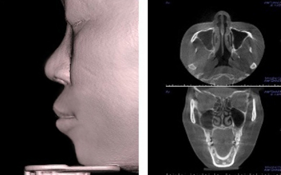 Rhinoplasty with 3-D scan: Safer surgery for nasal problems