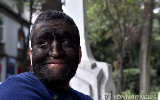 멕시코 ‘늑대인간’ 온 몸이 털로...