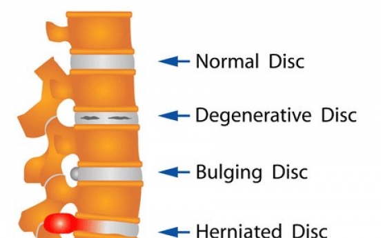 Rise in patients suffering herniated discs in neck