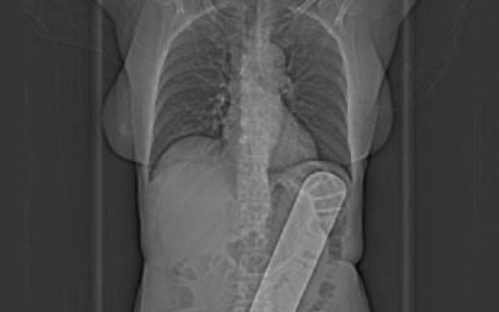 뱃속 33센티 ‘이물질’ 남긴 수술...