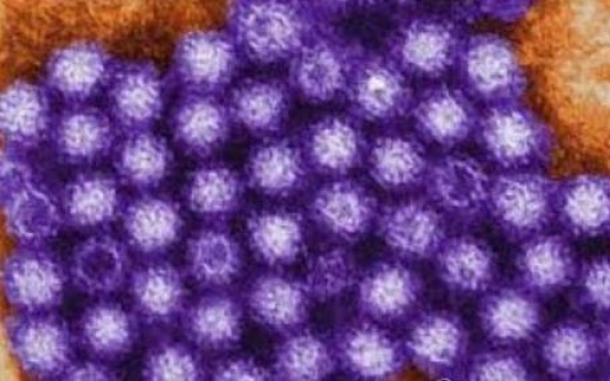 다발성 경화증...'고대 바이러스' 재활성화가 원인?