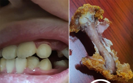 12-year-old boy injured from a metal screw found in a fried chicken wing