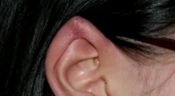 America’s new trend: elf ear surgery