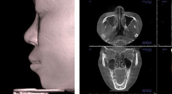 Rhinoplasty with 3-D scan: Safer surgery for nasal problems