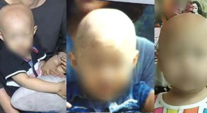 Two more children become bald after taking herbal medicine