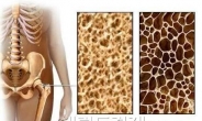 ‘골다공증’ 이렇게 막아라