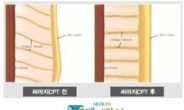 피부속 콜라겐을 활성화 시키는 써마지CPT