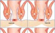 추운 겨울 더욱 고통스런 치질, 방치하면 더욱 악화