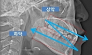 양악수술 회복기간 단축한 ‘Zoom-in 양악’