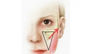 눈밑(하안검) 수술 시 중안면부도 같이 올려