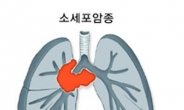 빠른 발견이 치명률 높은 소세포폐암 치료의 지름길