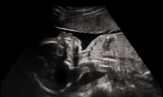 임신 22주 조산아 살수 있다…낙태허용 시기 법적 쟁점될 듯