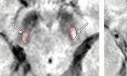 국내연구진, MRI 검사로 렘수면 행동장애 환자 파킨슨병 진행 여부 예측