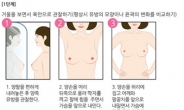 [김태열 기자의 생생건강] 전 여성에게 가장 위협적인 암인 ‘유방암’, 조기발견만하면 생존율은 높다