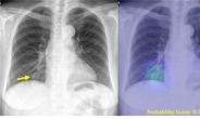 [김태열 기자의 생생건강] 진화하는 인공지능, 흉부X선으로 폐질환 한 번에 찾아낸다