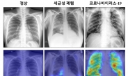 AI로 코로나19 진단 정확도 높인다…영상판독 정확도 86%