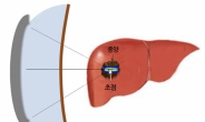 수술없이 초음파로 癌 종양만 골라 없앤다