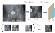 수학알고리즘+딥러닝 기술…‘소아 고관절’ 조기진단 정확도↑