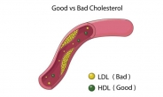 ‘좋은 콜레스테롤’도 과하면…‘이 병’ 위험 높아진다