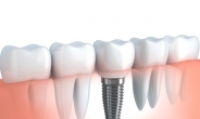 치아를 대신하는 제 3의 치아 임플란트, 기존 치아와 조화를 이루는 것이 중요!