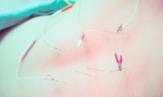 Electroacupuncture can improve sleep, study suggests