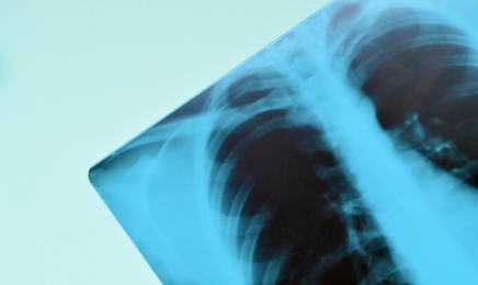 휴대용 X-ray 촬영 장치, 의료기관 밖에서 사용 가능해진다