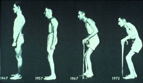 A series of pictures showing the progression of ankylosing spondylitis.(Pfizer)