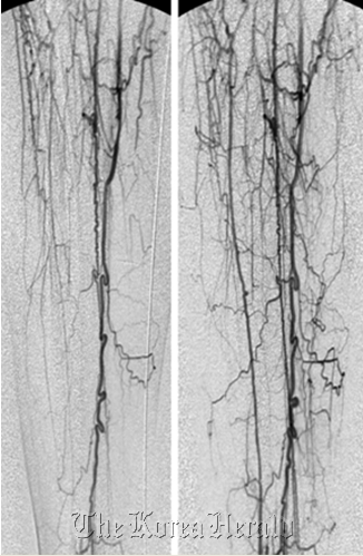 Left: Angiogram, Pre-stem-cell treatment. Right: Angiogram, six months after stem cell treatment. Lots of newly developed collateral vessels are shown.