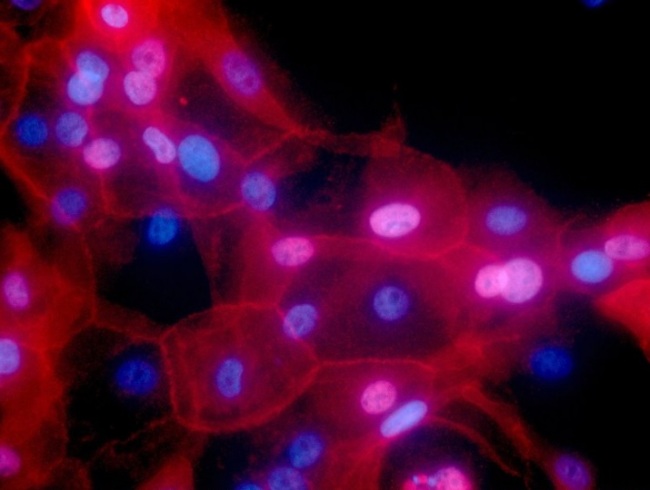 This undated fluorescence-colored microscope image made available by the National Institutes of Health in September 2016 shows a culture of human breast cancer cells. For the first time, one of the new immunotherapy drugs has shown promise against breast cancer in a large study that combined it with chemotherapy to treat an aggressive form of the disease. Results were discussed Saturday, Oct. 20, 2018 at a European Society for Medical Oncology conference in Munich and published by the New England Journal of Medicine. (National Cancer Institute-AP)