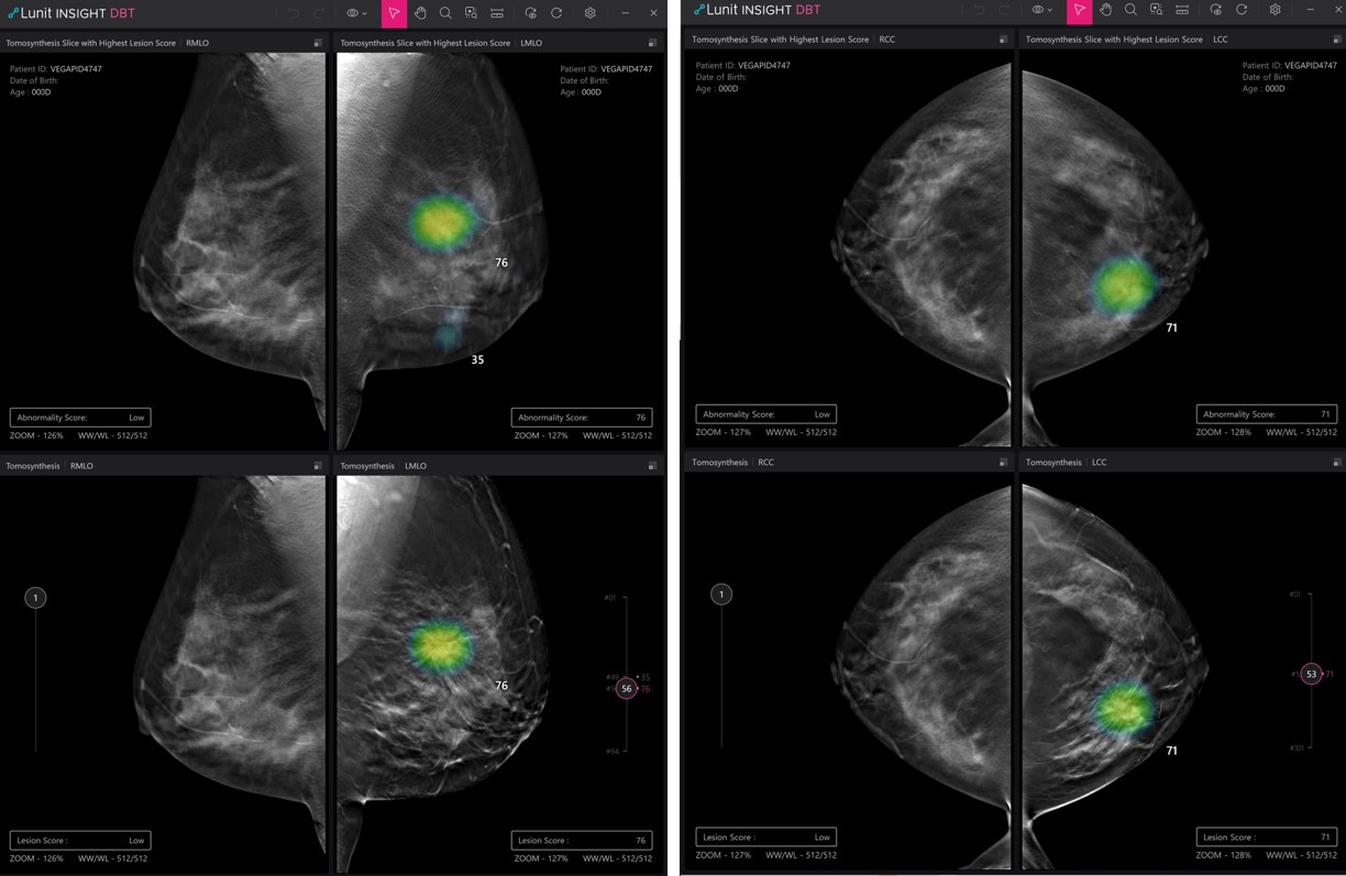 Demo pictures of Lunit Insight Digital Breast Tomosynthesis (Lunit)