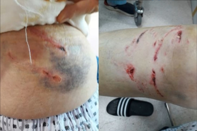 The victim of a dog attack posted a picture of her injuries after she was bitten by an unleashed dog on the street. (Bobaedream website)