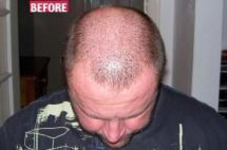 Solution to baldness, just $24