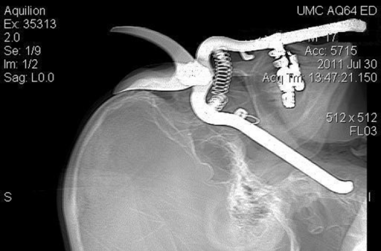 Ariz. man impaled by pruning shears