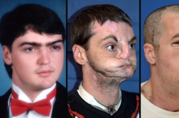 U.S. man injured in gun accident gets new face