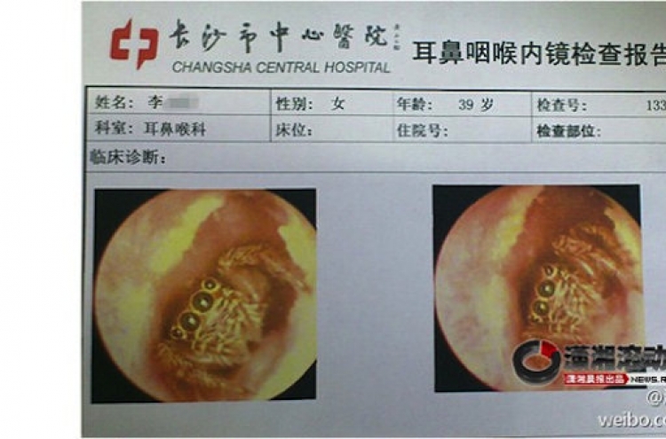 Chinese doctors remove spider from patient’s ear canal