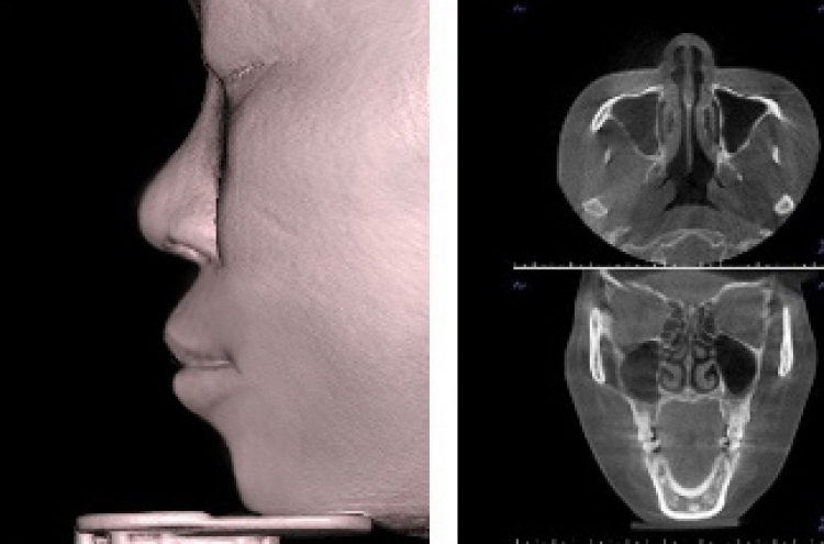 Rhinoplasty with 3-D scan: Safer surgery for nasal problems