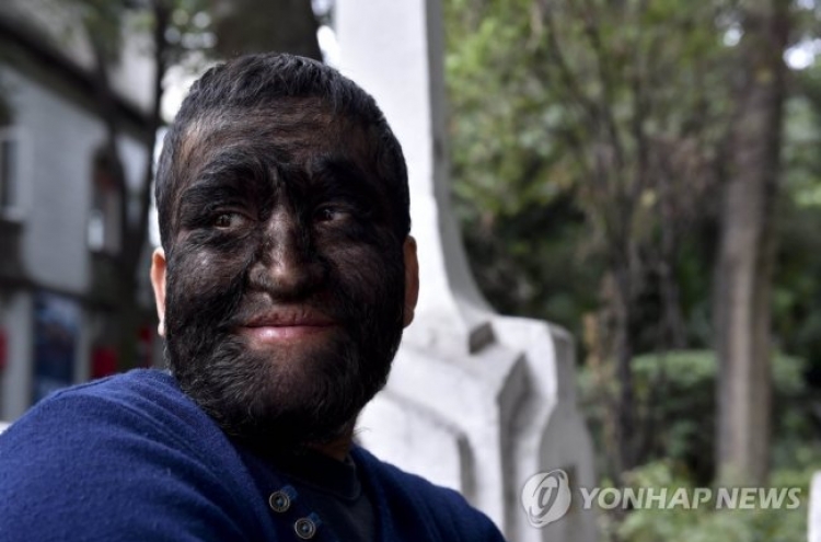 멕시코 ‘늑대인간’ 온 몸이 털로...