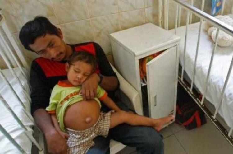 Doctors in Peru to remove 'parasitic twin'