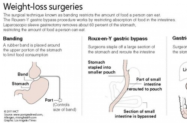 Surgery for fighting obesity