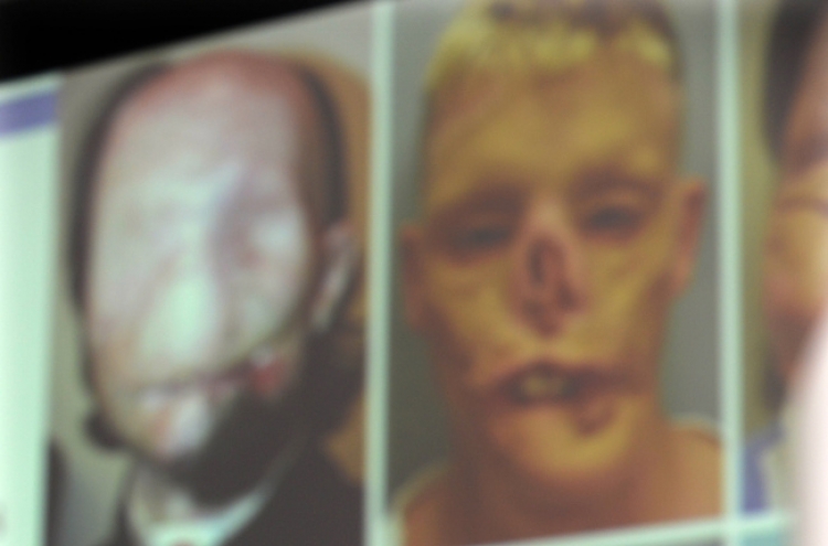 Face transplant patients thrive after operations