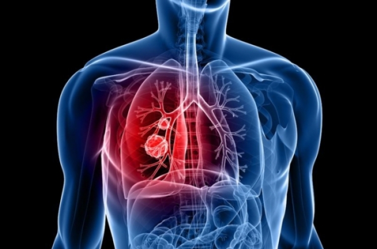 New microRNA may help diagnose lung cancer: study
