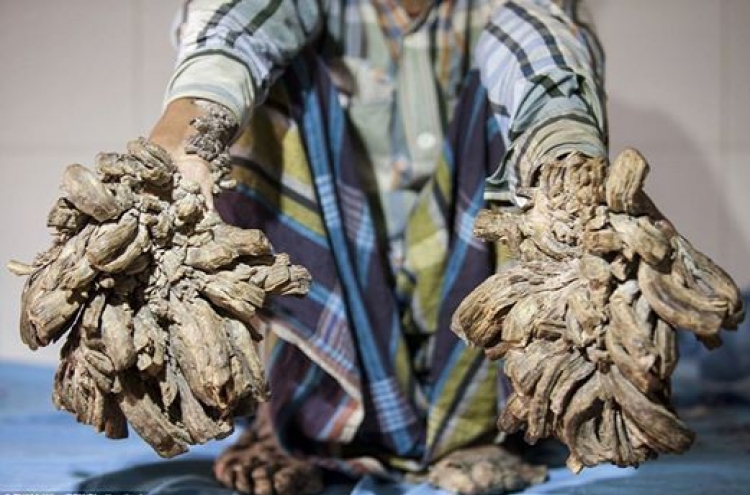 손과 발이 나무로 변한 남성, 전 세계 4번째 사례