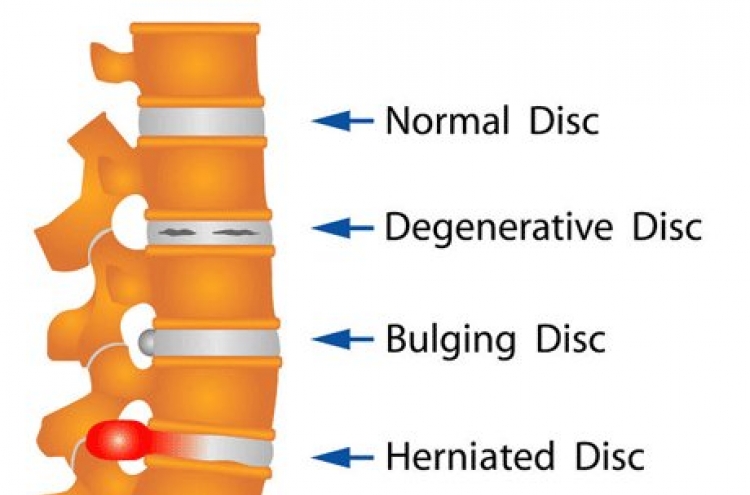 Rise in patients suffering herniated discs in neck